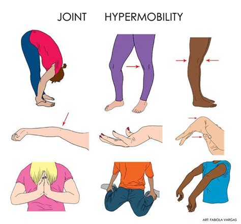 Hypermobile Ehlers-Danlos Syndrome - Healthwatch Central Bedfordshire