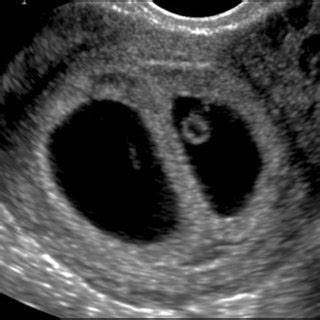 (PDF) Point-of-care ultrasound in obstetrics and gynecology