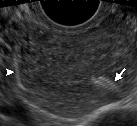 Essure Ultrasound