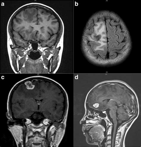 MRI scan of brain: a Coronal view of T1 W flair. The lesion was with ...