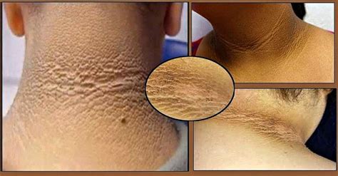 This “Leathery” Skin Condition Is a Warning Sign of Diabetes ...