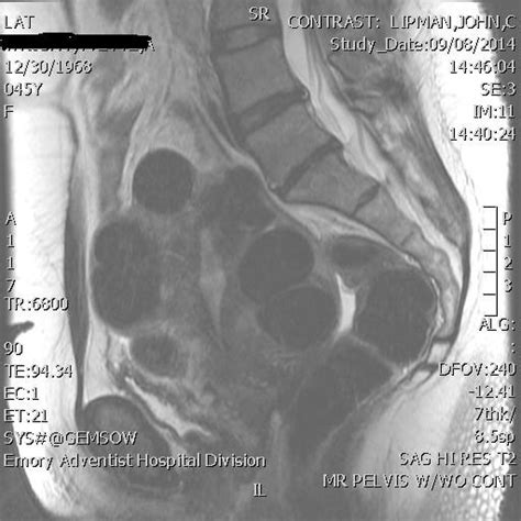 Uterine Fibroids