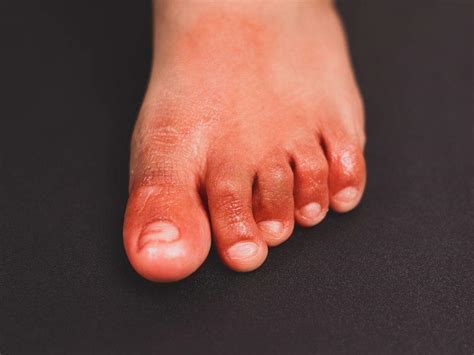 Covid Toes: What is COVID toes? Causes, symptoms and all you need to know