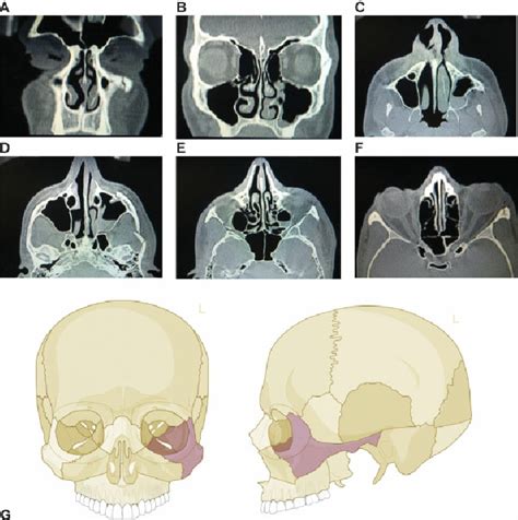 Zygoma fracture on the left side. Imaging: CT scan coronal view (A, B)... | Download Scientific ...