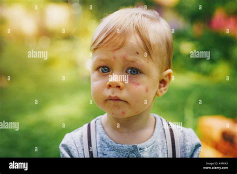 Mosquito bite face hi-res stock photography and images - Alamy