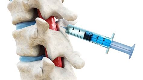 Epidural Injection in NJ | Northeast Spine and Sports Medicine