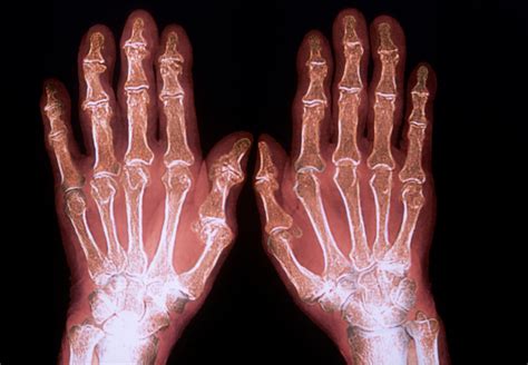 Undifferentiated Arthritis: Identifying Candidates for Early Treatment ...