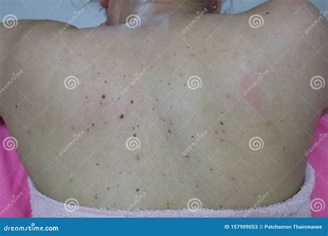 Close-up of the Skin on the Back of Women with Skin Diseases, Allergies, Rash, Redness, Itching ...