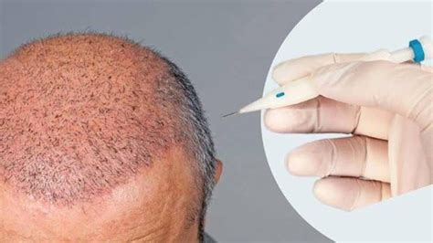 DHI hair transplant cost in India - Reniu Clinic, Mysore