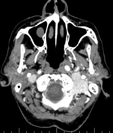 Glomus Tumor Radiology