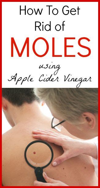 Apple Cider Vinegar Mole Removal Naturally | healthy Round