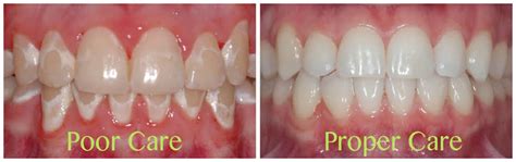 How to prevent white spots - All Smiles Dent Spa