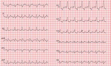 Atrial flutter 2 1 - lopitune