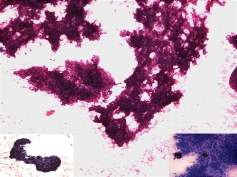 Cytological diagnosis of pigmented basal cell carcinoma | Annals of ...