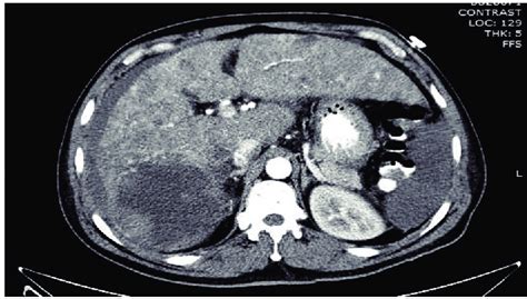 A Mri Liver In Showing One Of The Lesions Which Was Hyperintense Download Scientific | sexiezpix ...