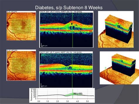 How 3 d oct enhances amd & dme treatment