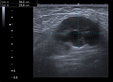 Ultrasound image of enlarged lymph node in the left axilla | Download Scientific Diagram