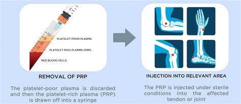 PRP injections – The Tendon Pain Clinic