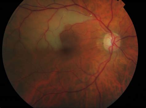 Retinal artery occlusion causes, symptoms, diagnosis, treatment & prognosis