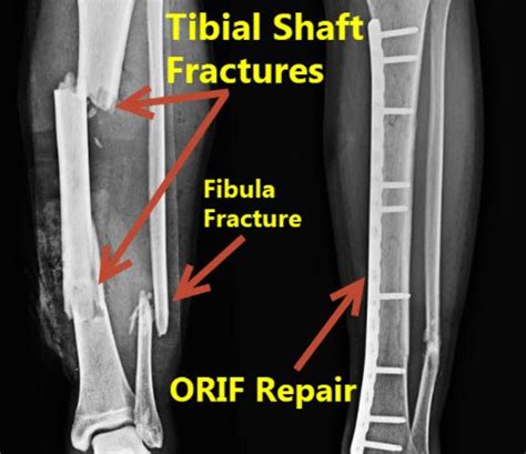 Tibia And Fibula Fracture