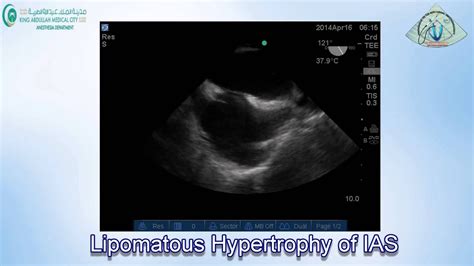 098 Lipomatous Hypertrophy of IAS - YouTube