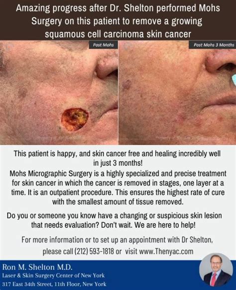 Mohs micrographic surgery for Basal Cell Carcinoma | Dr. Ron Shelton