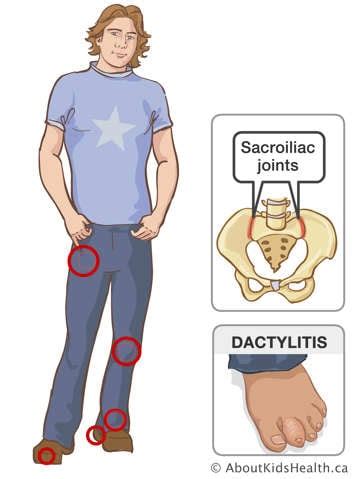 Enthesitis-related JIA