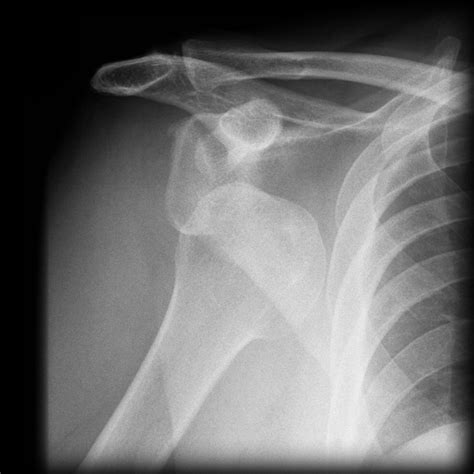 Dislocated Anterior Shoulder Dislocation