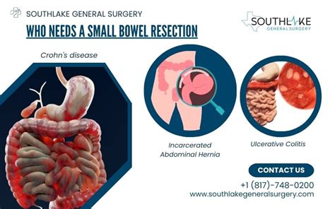 Understanding Small Bowel Resection - Southlake General Surgery