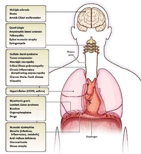 Phrenic Nerve Pacing: Current Concepts | IntechOpen