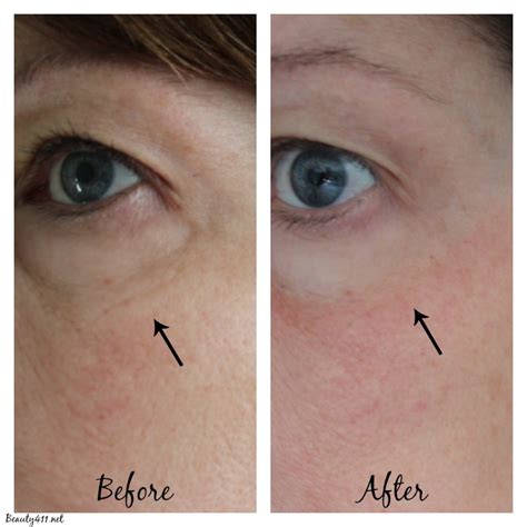 tria laser wrinkles before and after real results with tria eye wrinkle ...