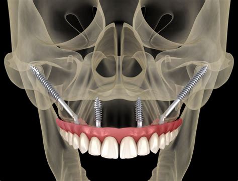 Zygomatic Dental Implants Fort Worth, Arlington, & Weatherford TX