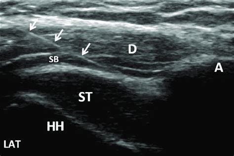 Subacromial Bursa Ultrasound