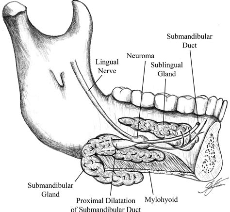 Unusual presentation of submandibular lingual nerve sheath tumour as sublingual stone | BMJ Case ...