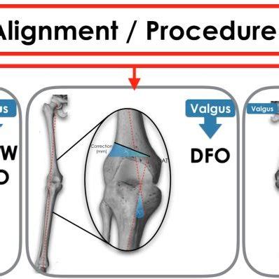 Example of a patient with squinting patella due to excess of tibial... | Download Scientific Diagram