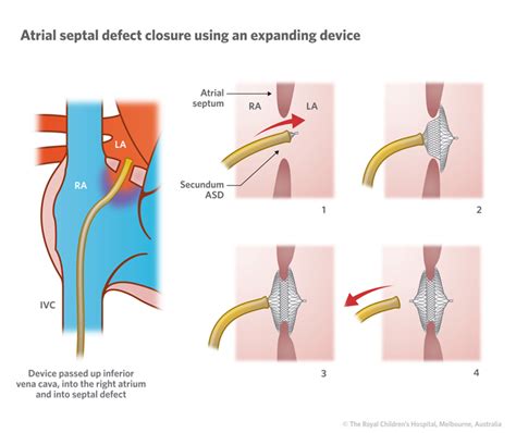 Cardiology : Atrial Septal Defect ASD