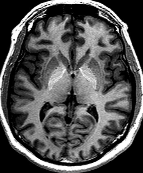 [Figure, MRI of thalamus Image courtesy S Bhimji MD] - StatPearls ...