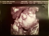 Parents Create Bucket List for Unborn Baby With Anencephaly Expected to ...