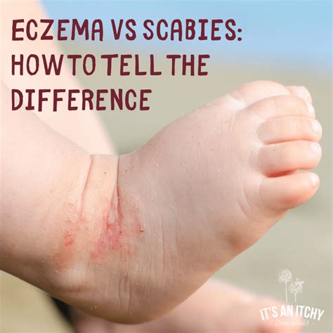 What's the Difference Between Eczema vs. Scabies? | It's an Itchy ...