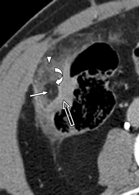 Appendix Epiploica Ct