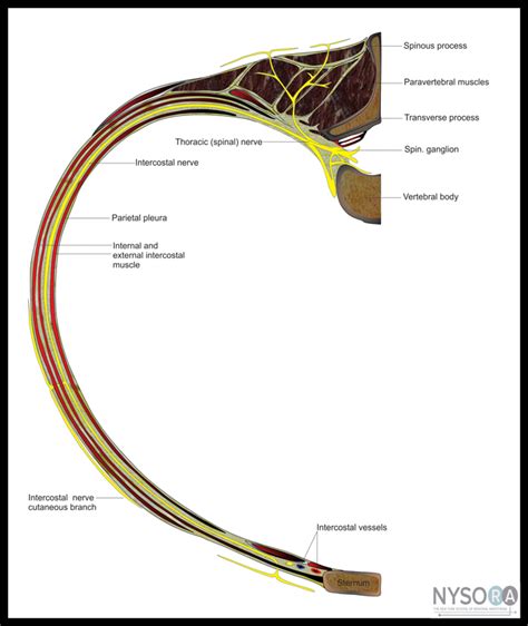 Intercostal Block - NYSORA The New York School of Regional Anesthesia