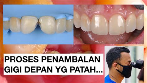 Proses Penambalan Gigi depan yang patah | Tambal Gigi | Dokter Gigi Griya RR - YouTube