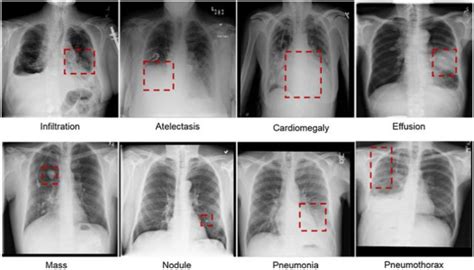 Chest X Ray Pneumonia