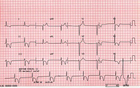 Case B11. Junctional Rhythm. St Emlyn's ECG Library • St Emlyn's