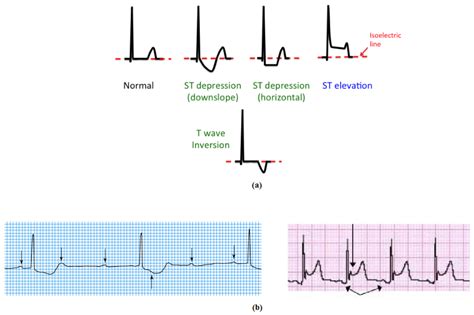 An Automated High-Accuracy Detection Scheme for Myocardial Ischemia Based on Multi-Lead Long ...