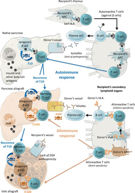 Pathophysiology of type 1 diabetes, autoimmune recurrence and allograft ...