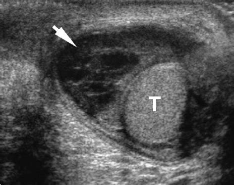 Pyocele. Transverse sonogram in an 8-year-old with scrotal swelling 5 ...