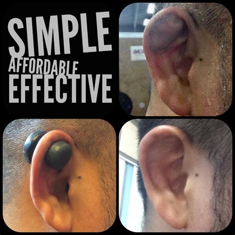 Rescue Ear Magnetic Discs For Cauliflower Ear Prevention And Treatment | ubicaciondepersonas ...