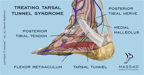 Tibial Nerve Entrapment