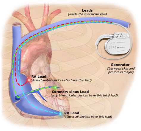 Pacemaker terminology - Questions and Answers in MRI